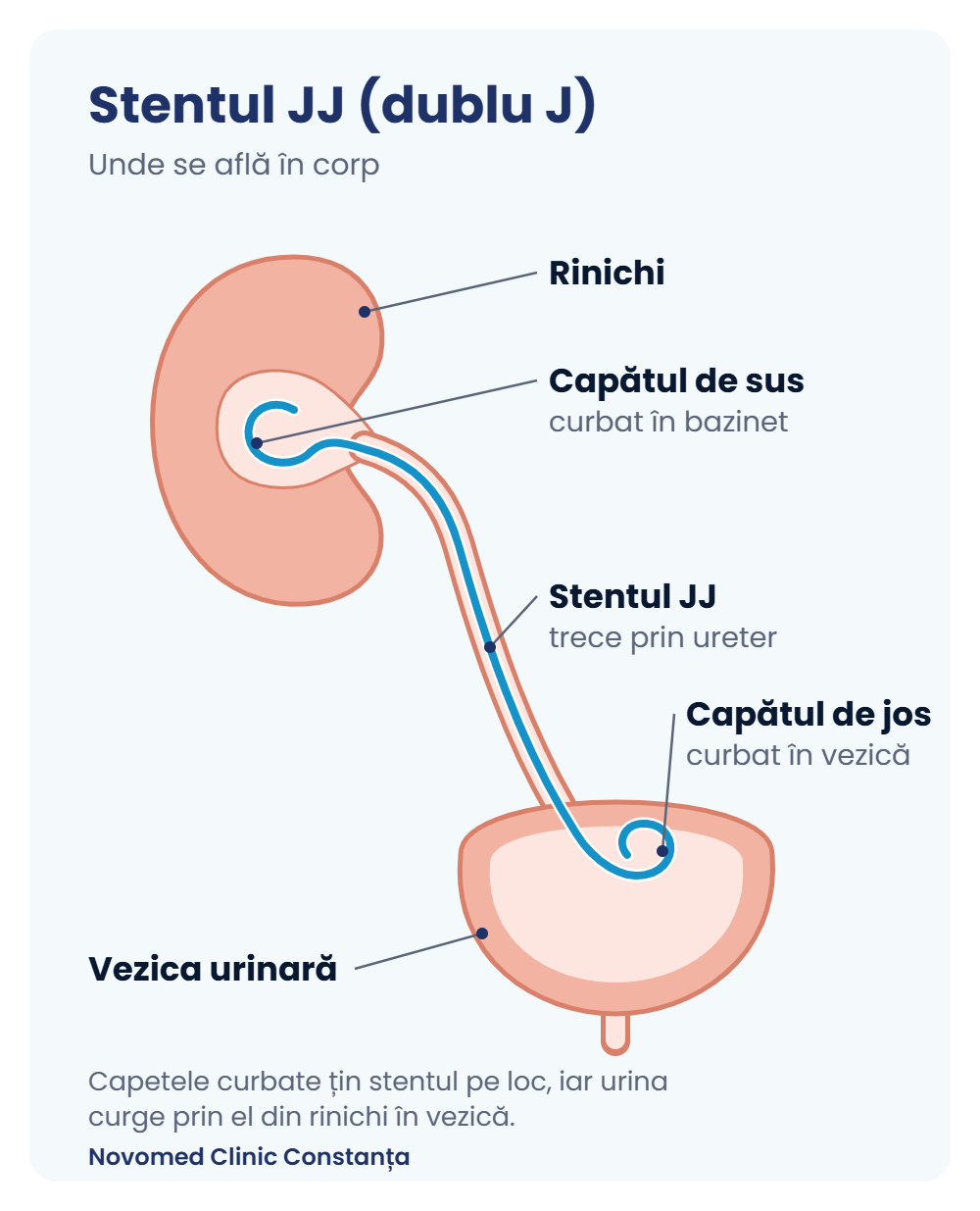 Stentul JJ (dublu J), unde se află în corp Schemă: stentul JJ montat între rinichi și vezica urinară, cu capetele curbate în bazinet și în vezică