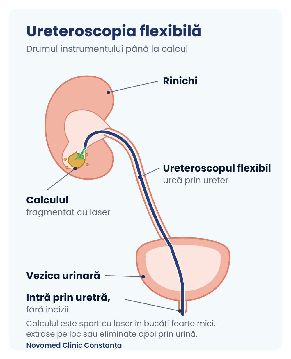 Ureteroscopia flexibilă, drumul instrumentului Schemă: ureteroscopia flexibilă, drumul instrumentului prin uretră, vezică și ureter până la calculul din rinichi