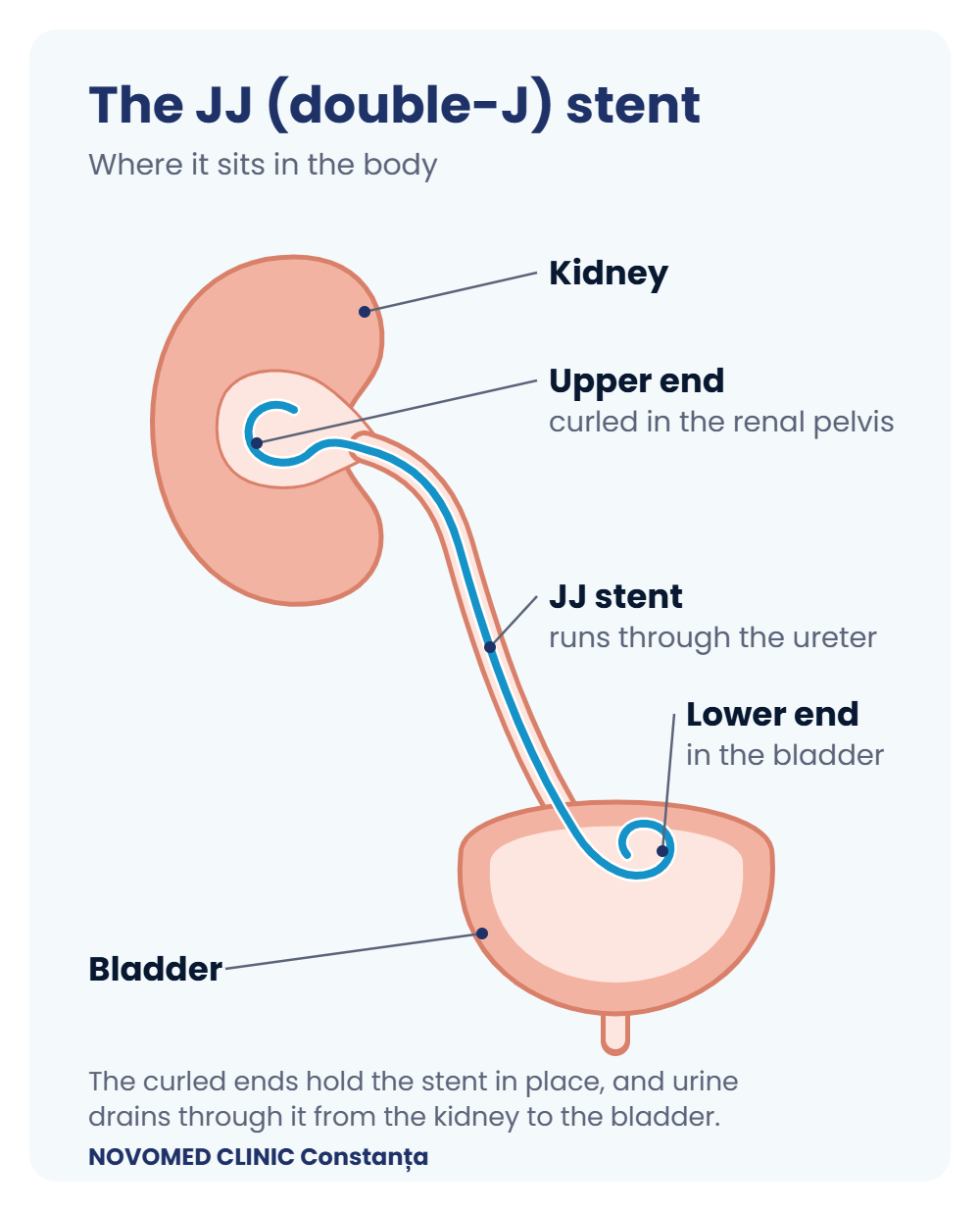 The JJ (double-J) stent and where it sits in the body Diagram: a JJ stent placed between the kidney and the bladder, with its curled ends in the renal pelvis and in the bladder