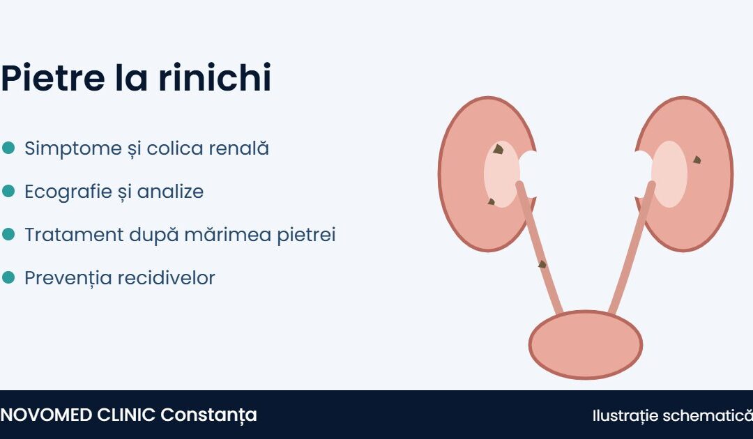 Pietre la rinichi: simptome, cauze, diagnostic, tratament și prevenție